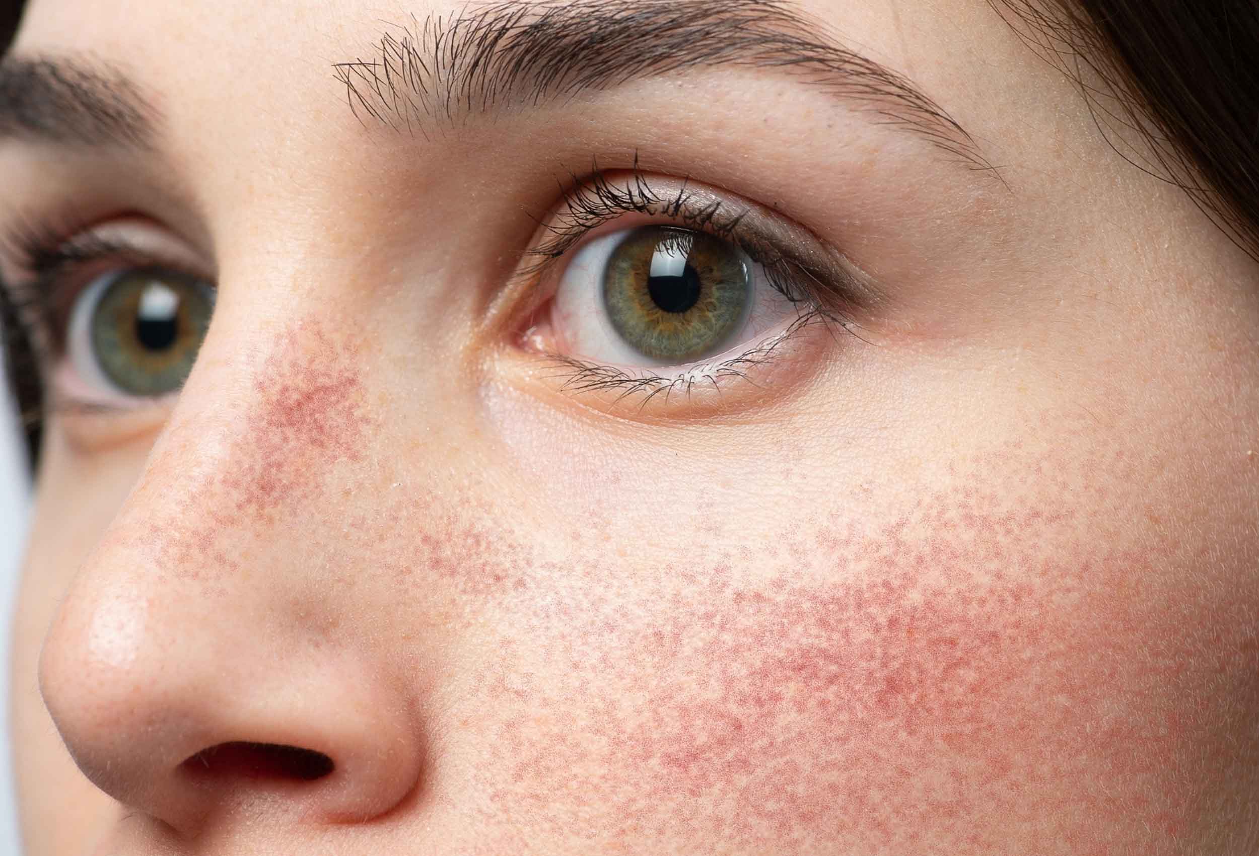 Rosacea treatment at Glow Theory Aesthetic & Dermatology Studio in Carlsbad