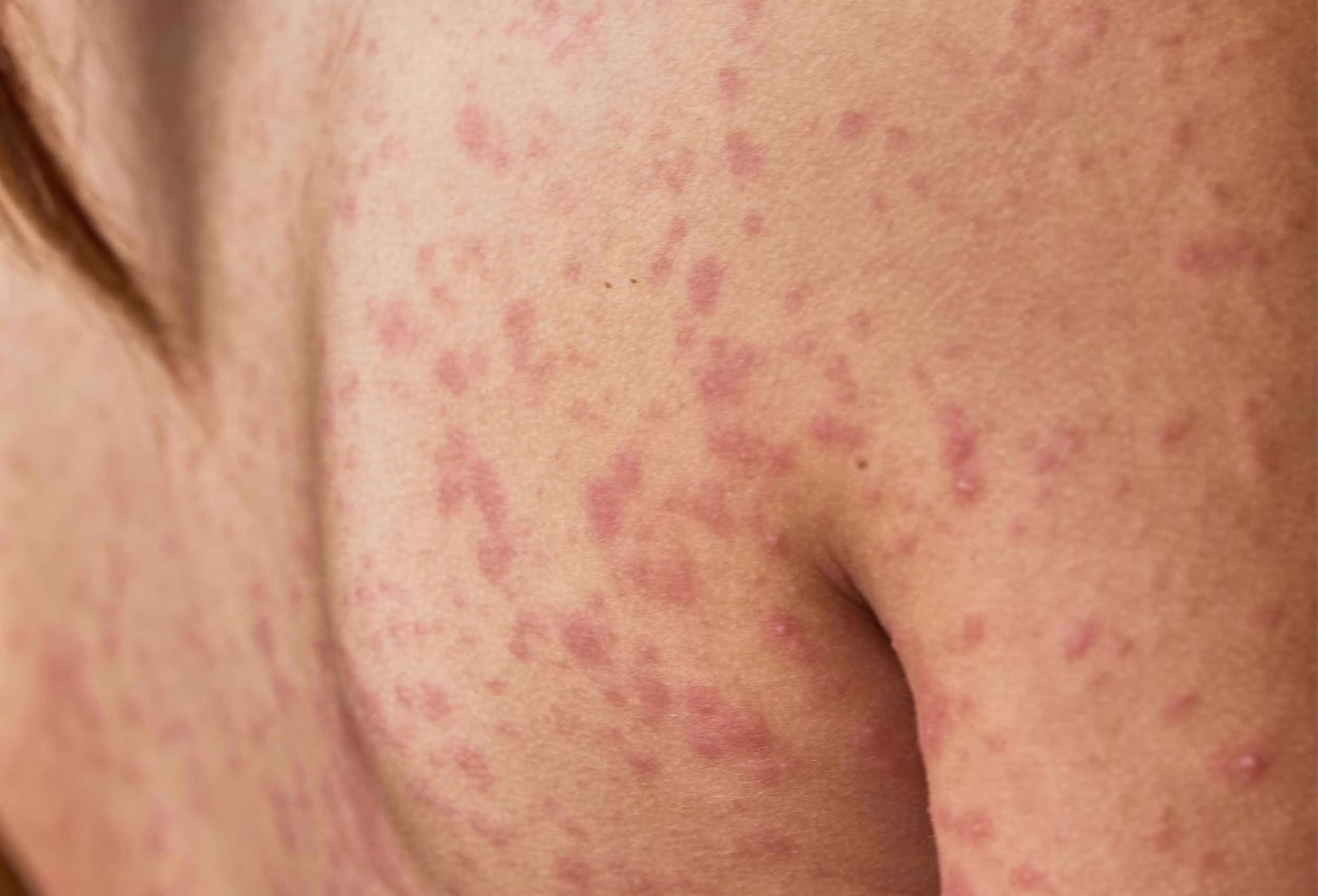 Skin rash diagnosis and treatment at Glow Theory Aesthetic & Dermatology Studio in Carlsbad
