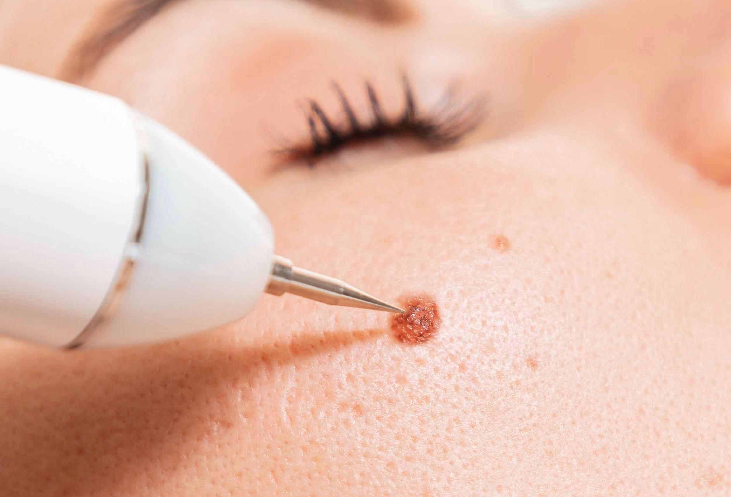 Wart removal at Glow Theory Aesthetic & Dermatology Studio in Carlsbad