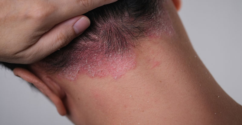 Why choose Glow Theory for psoriasis care in Carlsbad