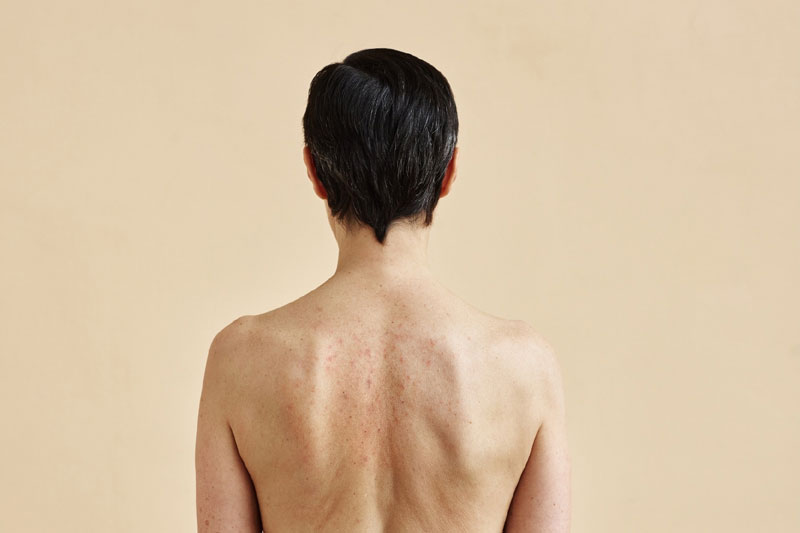 Why choose Glow Theory for skin rash treatment in Carlsbad