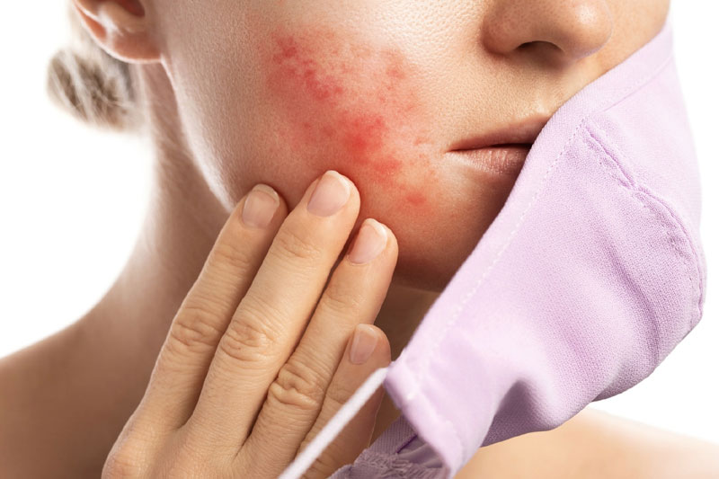 Why choose Glow Theory for rosacea treatment in Carlsbad