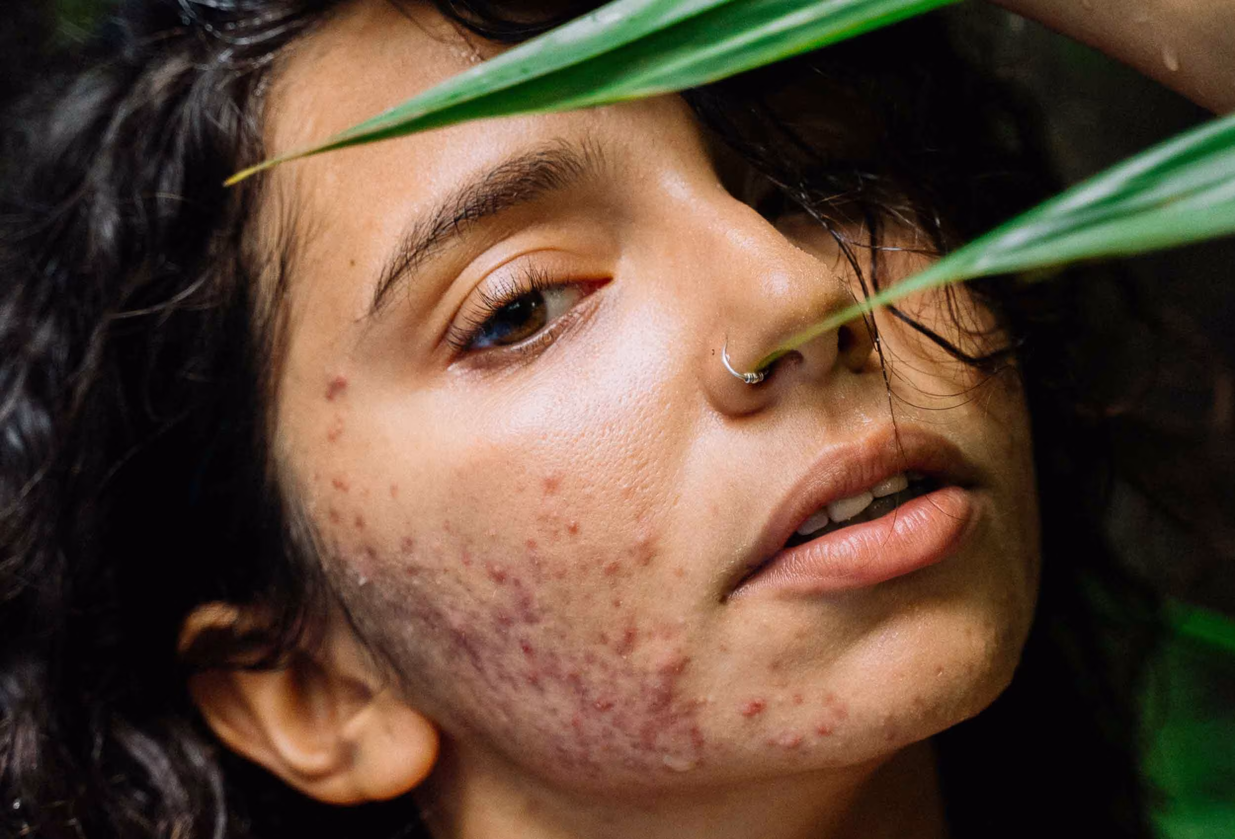 Acne treatment with Forever Clear BBL at Glow Theory in Carlsbad, CA