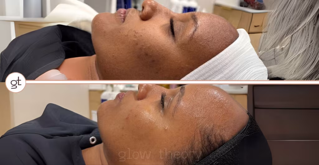 Chemical Peel Before After