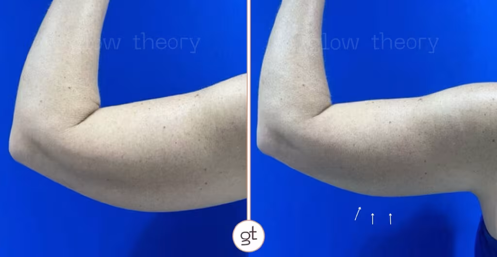 Coolsculpting Elite Before After Arms