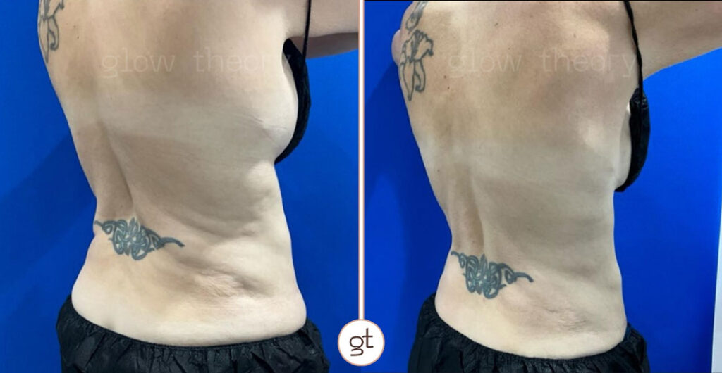 Coolsculpting Elite Before After Bra