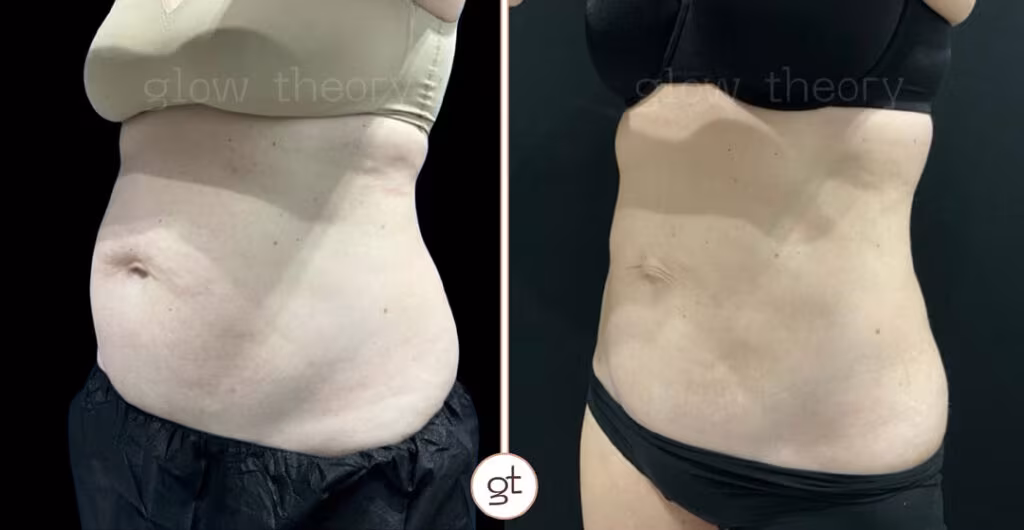 Coolsculpting Elite Before After Stomach