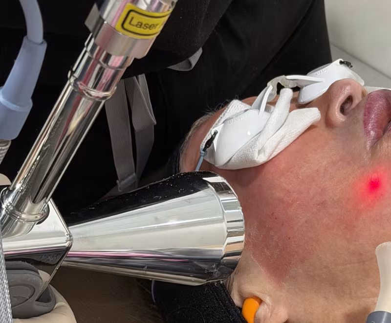 Treatable areas for Erbium laser resurfacing including deep perioral wrinkles, acne scars, neck, and decollete at Glow Theory Carlsbad.